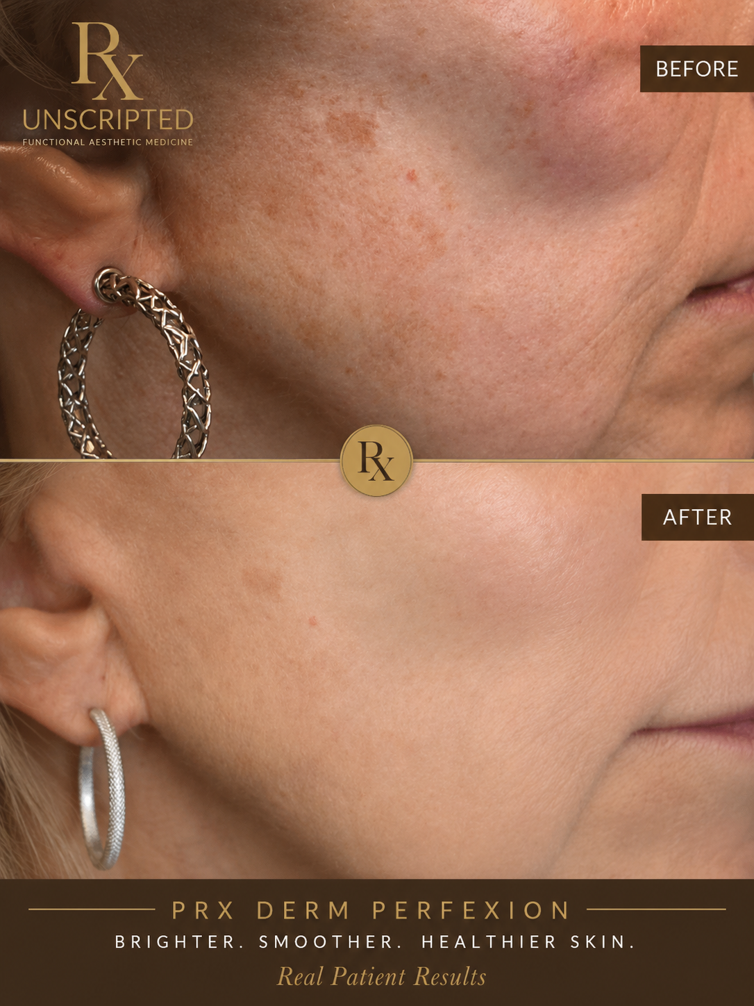 PRX Derm Perfexion before and after showing improvement in skin tone, pigmentation, and overall skin brightness.