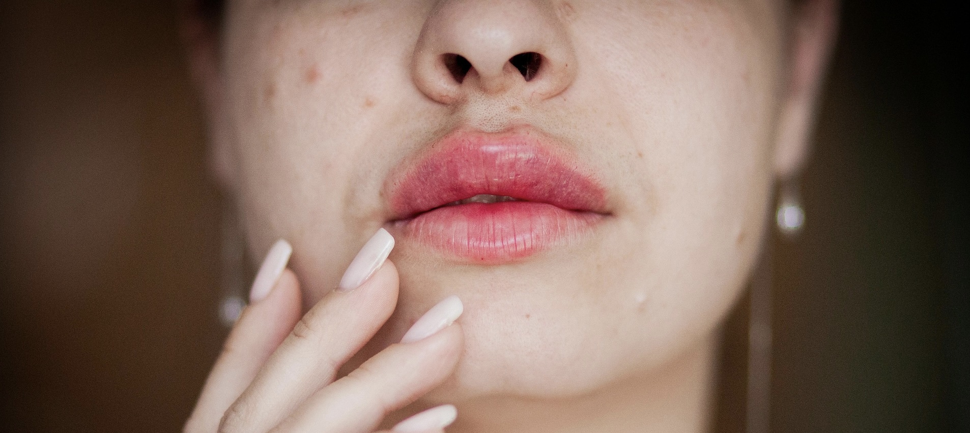 Acne Treatment in North Dallas: Why Most Treatments Fail (And What Actually Works)