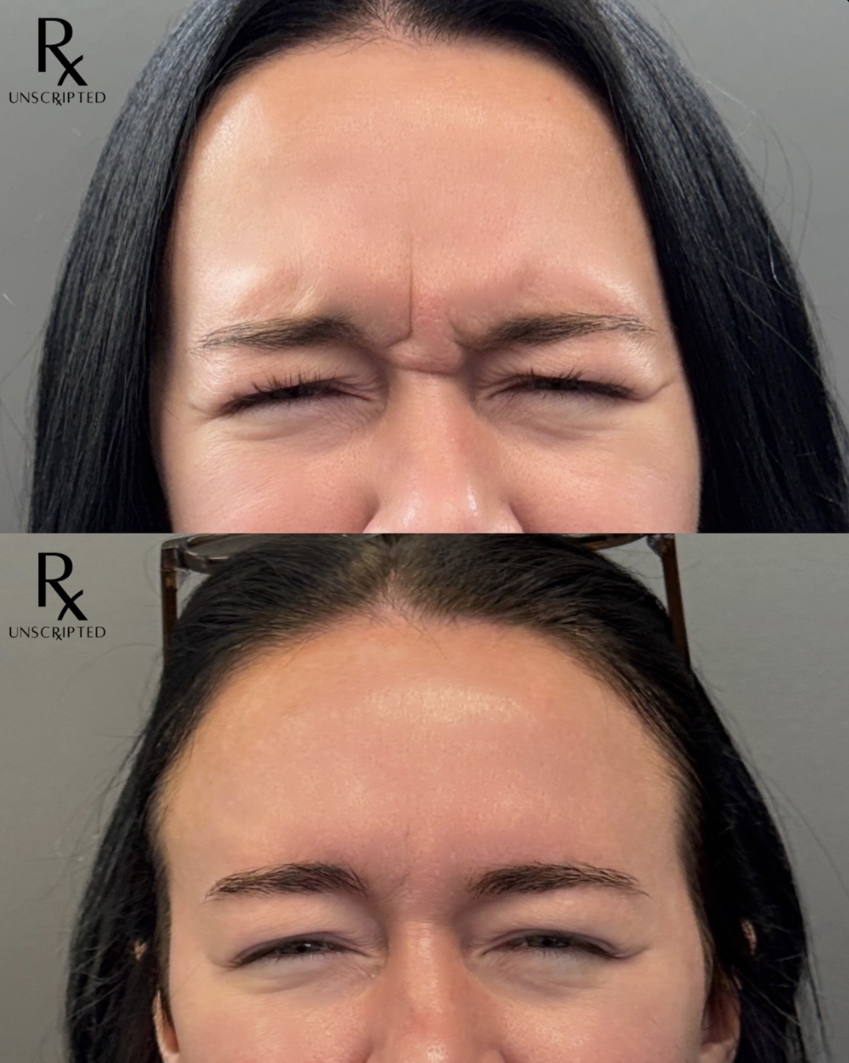 Botox for Frown Lines (11's): How to Soften the Line Between Your Brows Naturally