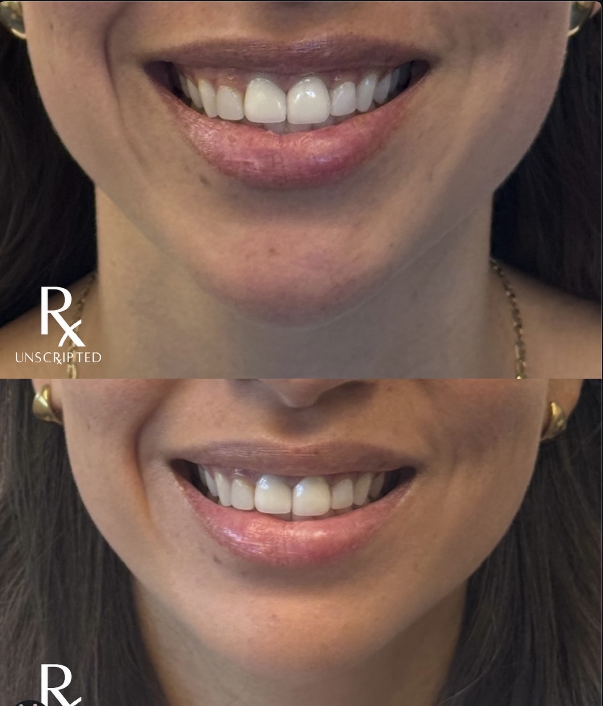 Botox for Gummy Smile: A Subtle Way to Create Smile Balance