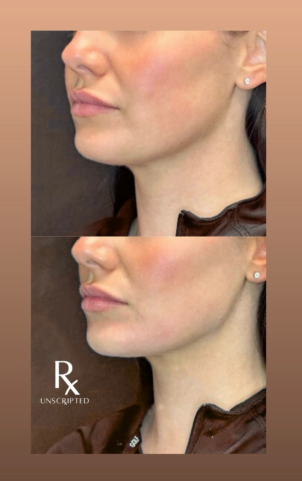 The Subtle Art of Looking Refreshed: Why Natural Results Are the New Standard in Aesthetics