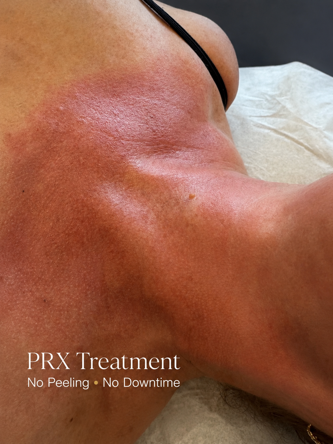 PRX Treatment for Chest and Neck in North Dallas: No Downtime, No Peeling, and Less Sun Sensitivity Than Laser