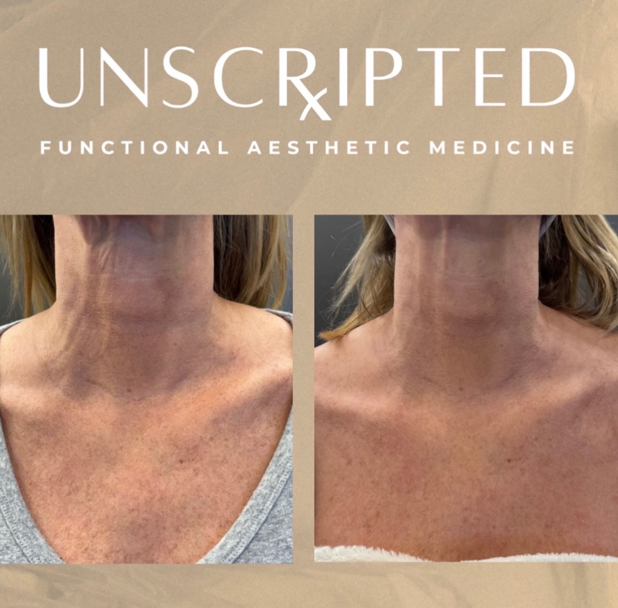 PRX for Chest and Neck: Smoother Skin Without Needles or Downtime