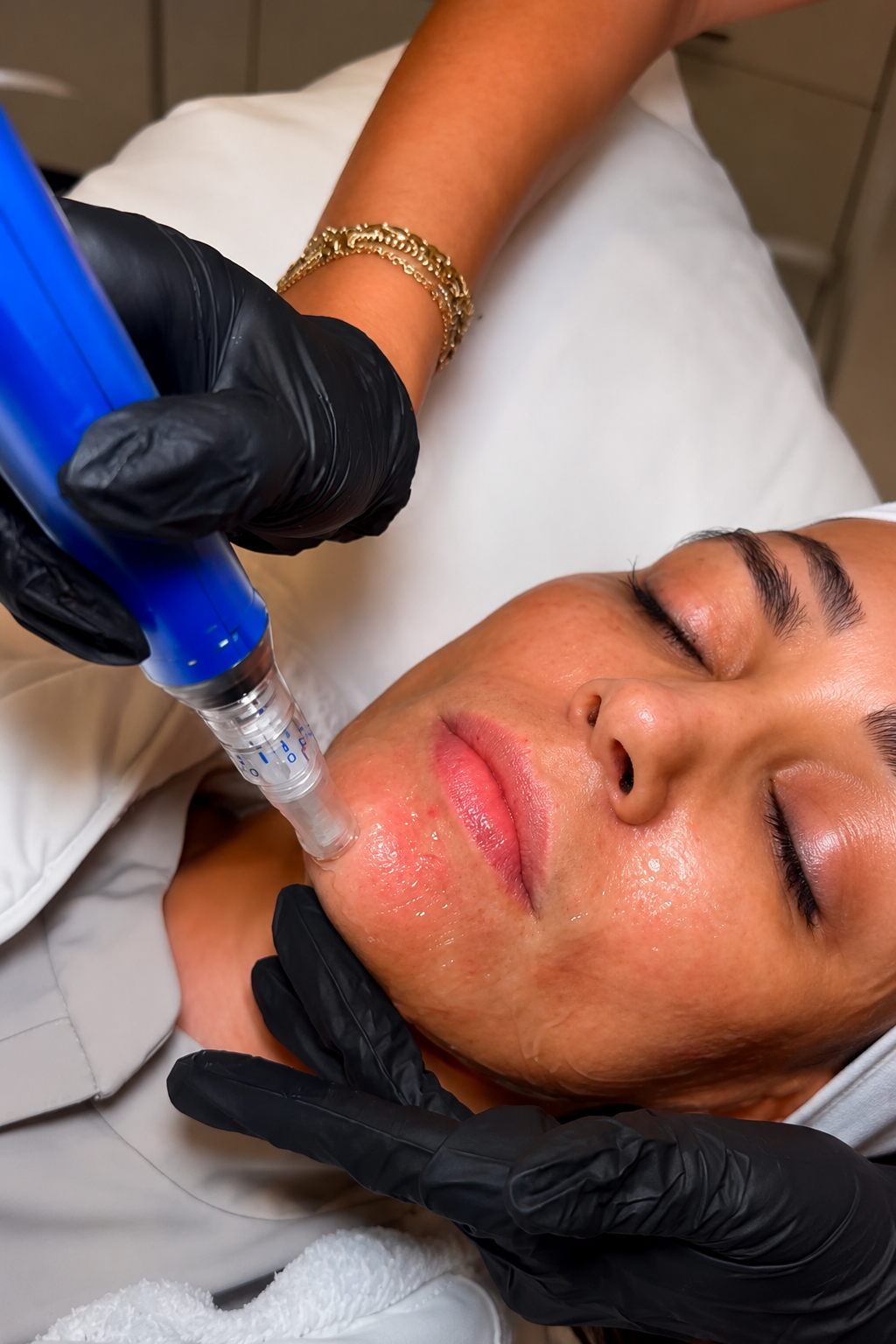 PRX + Microneedling: A Smarter Way to Improve Texture, Tone, and Glow in North Dallas