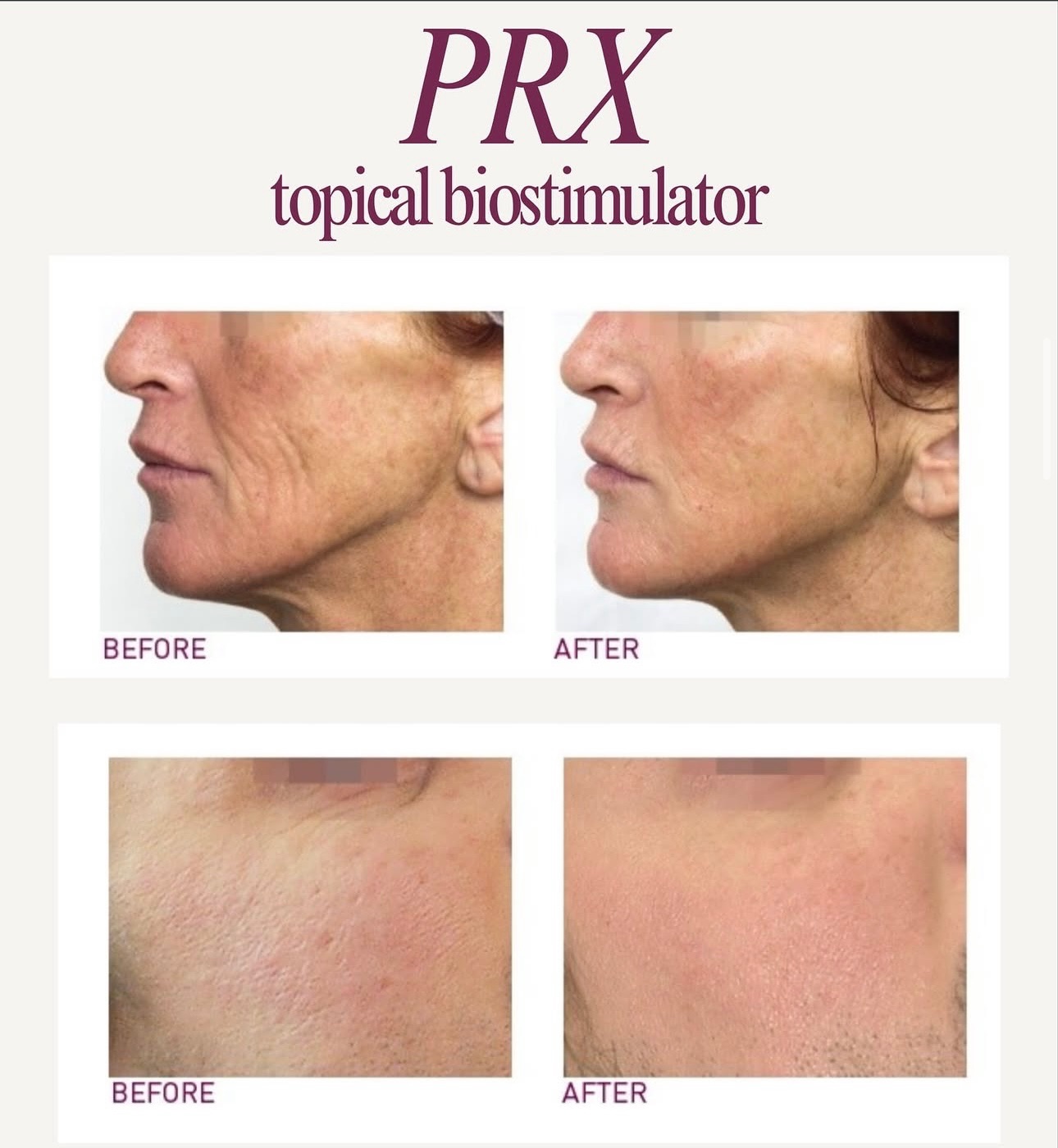 PRX-T Plus: Collagen Renewal Without Downtime