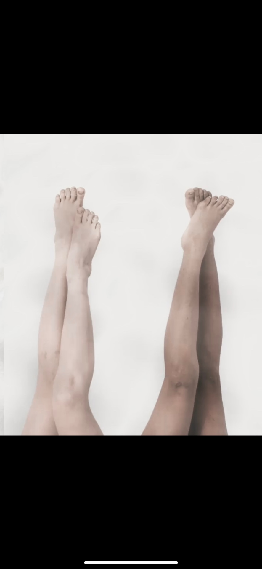 Clean, healthy legs positioned upward showcasing sclerotherapy results